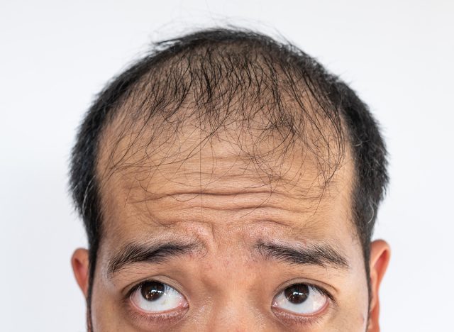 Cropped shot of Asian man worry about his hair loss and baldness problem. Conceptual of hair problem on men's head.
