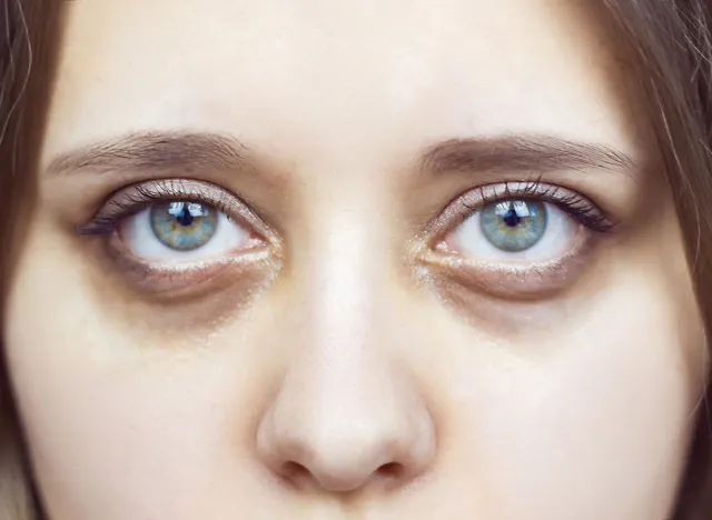 Cropped shot of a young female face. Green eyes with dark circles under the eyes. Bruises under the eyes are caused by fatigue, nervousness, lack of sleep, insomnia and stress