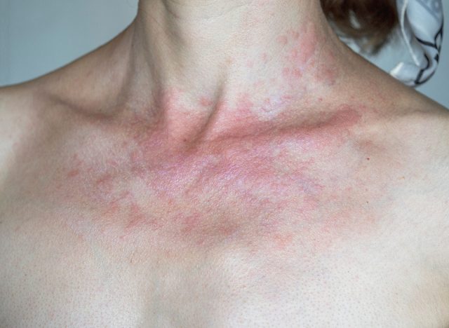 Solar dermatitis. Woman with red sunburned skin against gray background, closeup.