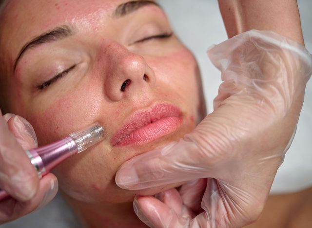 Cosmetician makes microneedling, care to the patient using dermapen