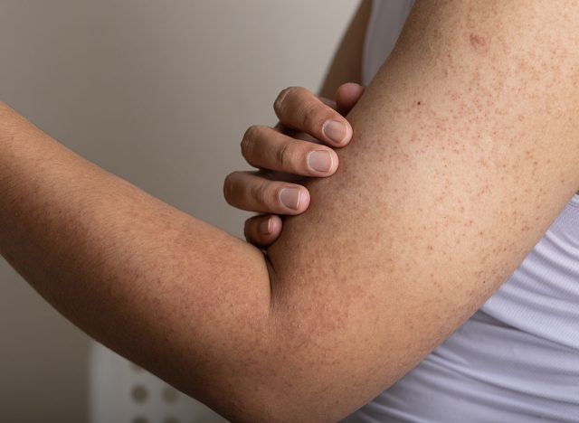 Keratosis Pilaris a harmless skin condition that causes dry, rough patches and tiny bumps, often on the upper arms