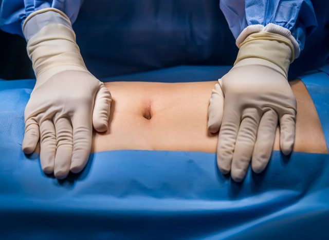 Abdomen prepare for abdominal surgery with sterile drape.Surgeon or nurse in blue uniform put hands with glove on patient.Abdominal surgery inside operating room in hospital.Hernia repair surgery.