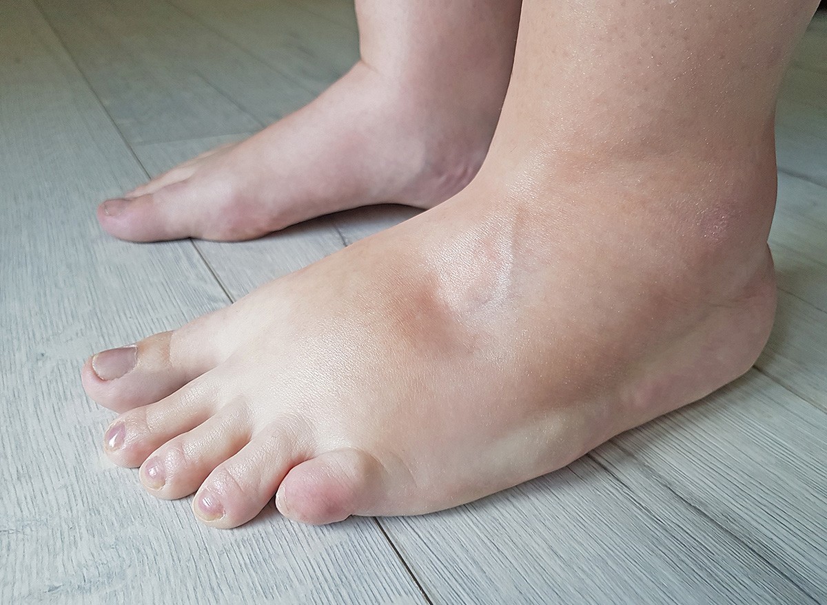Swollen feets because water retention in the body